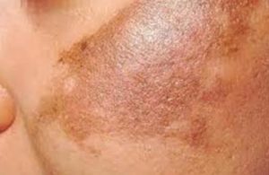 The skincare potential of silibinin 3 Melasma